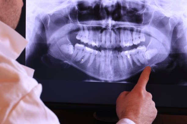 Best Emergency Tooth Extraction in Plum Grove, TX